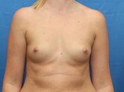 Before Results for Breast Augmentation