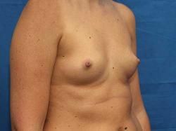 Before Results for Breast Augmentation