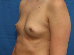Before Results for Breast Augmentation