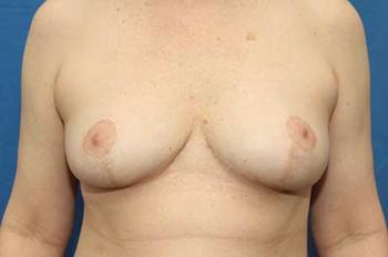 After Results for Breast Lift / Mastopexy