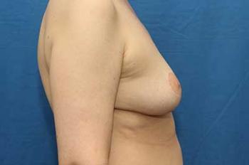 After Results for Breast Lift