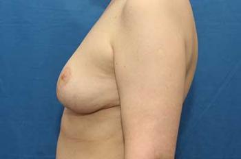 After Results for Breast Lift