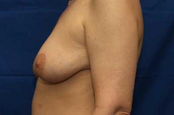 Before Results for Breast Lift