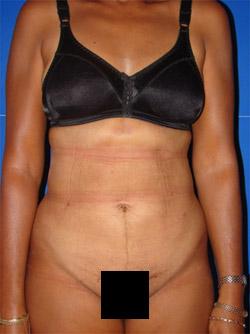 After Results for Liposuction