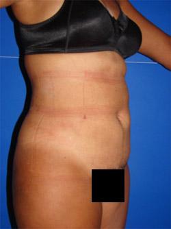 After Results for Liposuction