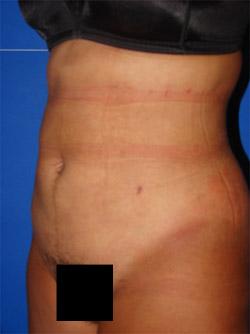 After Results for Liposuction