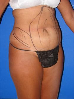 Before Results for Liposuction