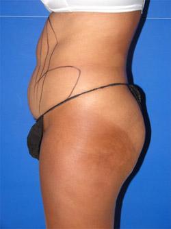 Before Results for Liposuction