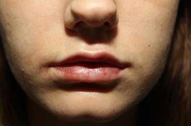 After Results for Tissue Fillers, Lip Augmentation