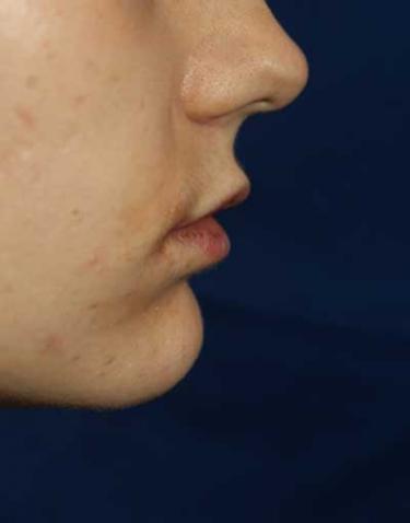 After Results for Lip Augmentation