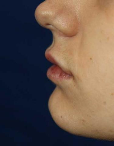 After Results for Lip Augmentation