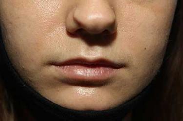 Before Results for Tissue Fillers, Lip Augmentation