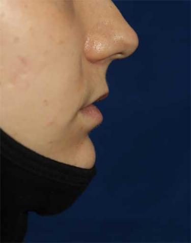 Before Results for Lip Augmentation