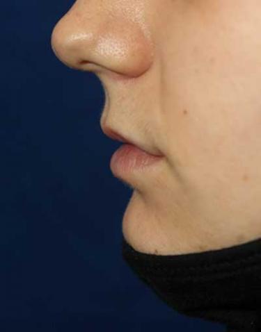 Before Results for Lip Augmentation