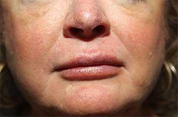 After Results for Tissue Fillers, Lip Augmentation