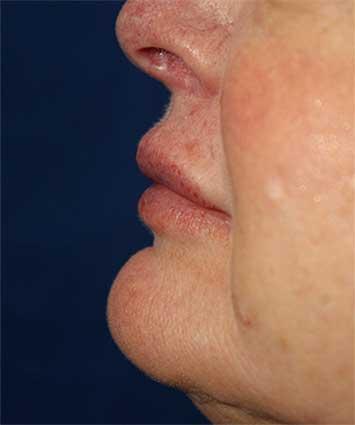 After Results for Tissue Fillers, Lip Augmentation