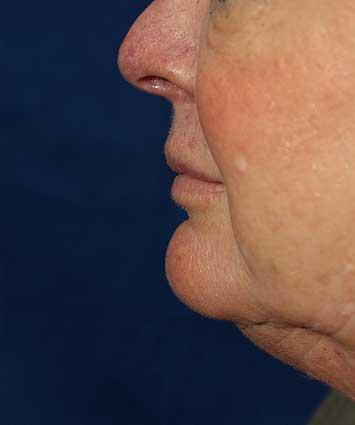 Before Results for Tissue Fillers, Lip Augmentation