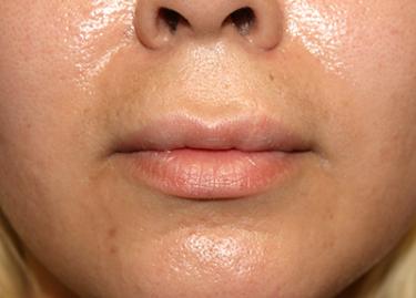 After Results for Lip Augmentation