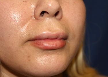 After Results for Lip Augmentation