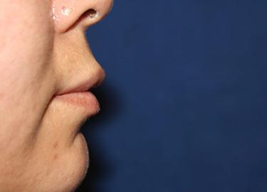 After Results for Lip Augmentation