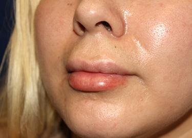 After Results for Lip Augmentation