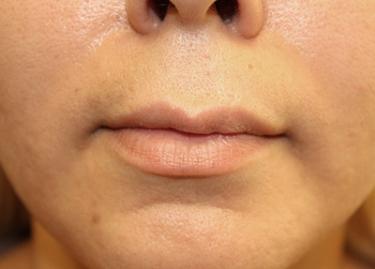 Before Results for Tissue Fillers, Lip Augmentation