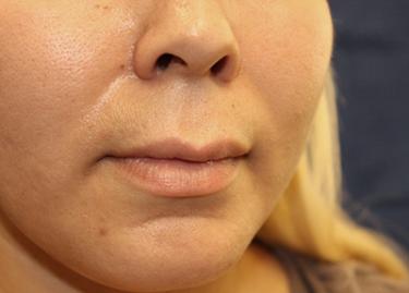 Before Results for Tissue Fillers, Lip Augmentation