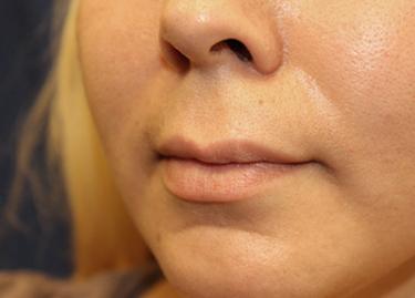 Before Results for Lip Augmentation