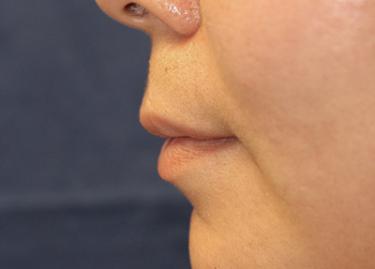 Before Results for Lip Augmentation