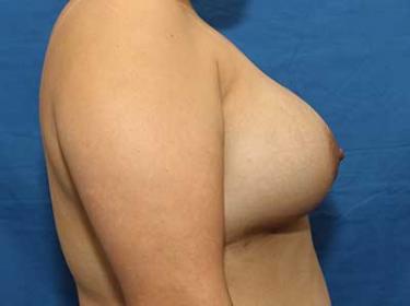 After Results for Breast Augmentation