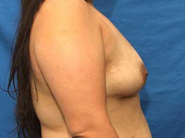 Before Results for Breast Augmentation
