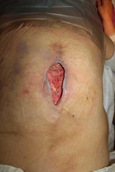 Before Results for Wound Care