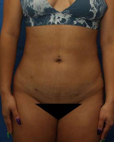 After Results for Liposuction