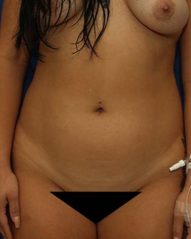 Before Results for Liposuction