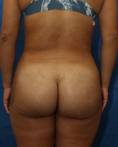 After Results for Gluteal Augmentation