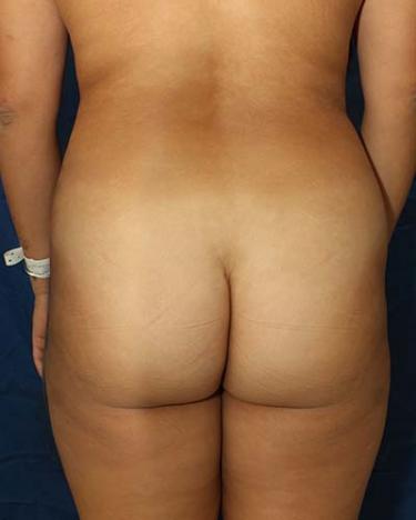 Before Results for Brazilian Butt Lift / Gluteal Augmentation