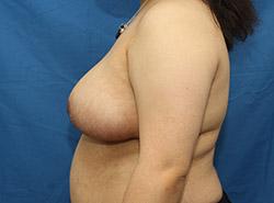 After Results for Breast Reduction