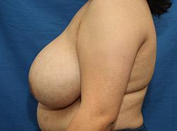 Before Results for Breast Reduction