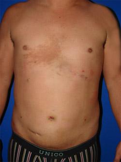 After Results for Liposuction