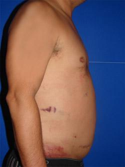 After Results for Liposuction