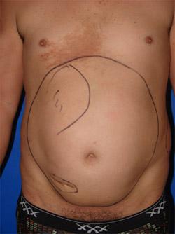 Before Results for Liposuction