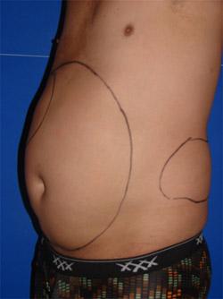 Before Results for Liposuction