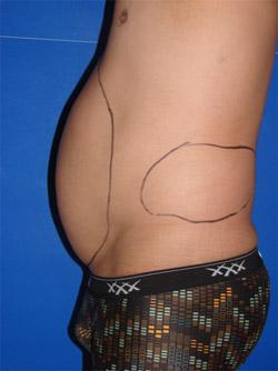 Before Results for Liposuction