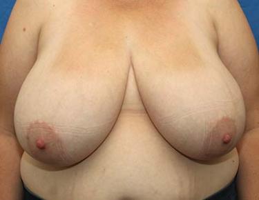 Before Results for Breast Reduction