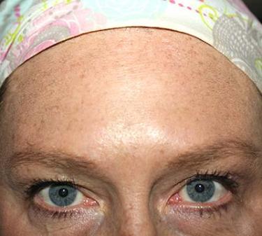 After Results for Neuromodulators (Botox / Dysport)