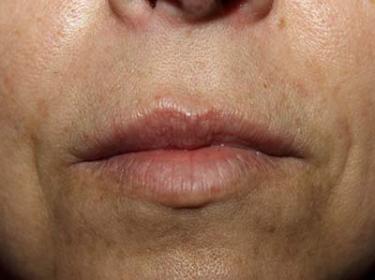 After Results for Lip Augmentation