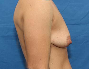 Before Results for Breast Augmentation
