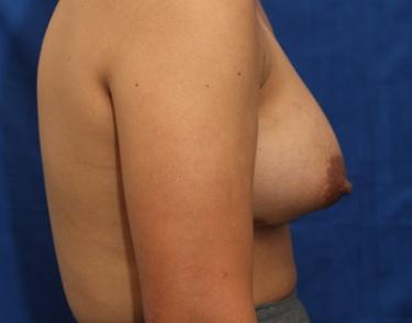 After Results for Breast Augmentation