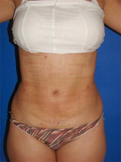 After Results for Liposuction