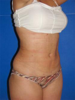 After Results for Liposuction